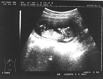 http://www.ob-ultrasound.net/images/14weeks.jpg