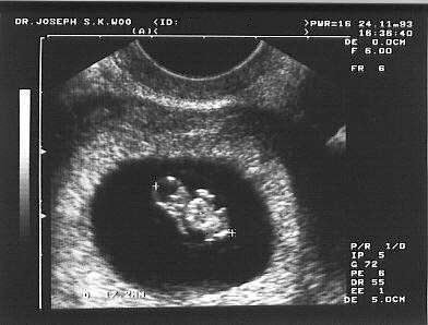 http://www.ob-ultrasound.net/images/stella.jpg