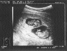 http://www.ob-ultrasound.net/images/twins.jpg