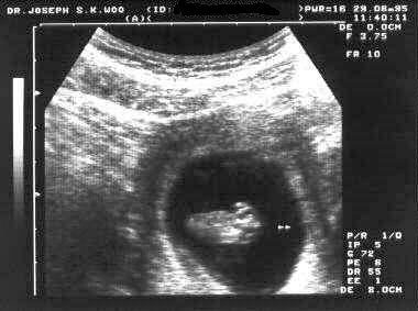 http://www.ob-ultrasound.net/images/us10.jpg