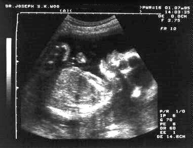 http://www.ob-ultrasound.net/images/us6-2.jpg