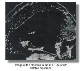 placental localization with A-scan